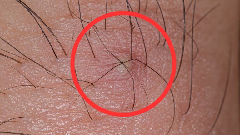 Ingrown Hair Turned Into Hard Lump Under Skin What Is It And How To Treat It Feminine Health 