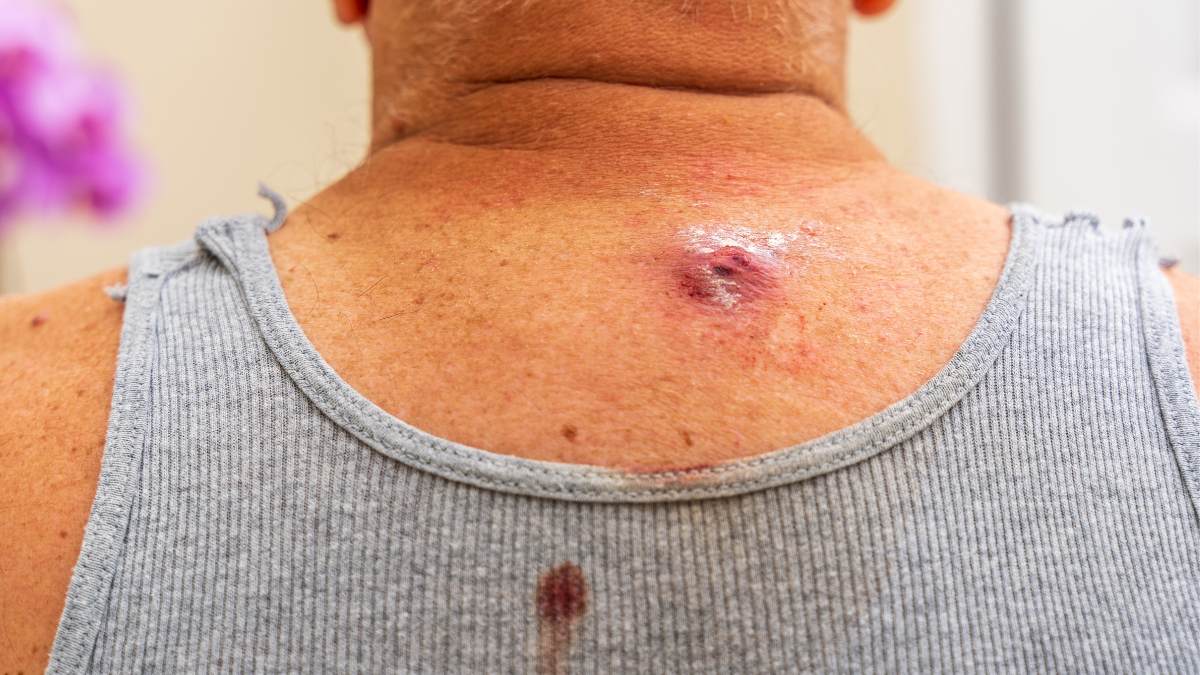 ingrown-hair-turned-into-hard-lump-under-skin-what-is-it-how-to