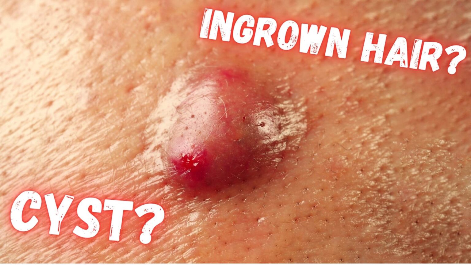 Ingrown Hair Turned Into Hard Lump Under Skin What Is It And How To Treat It Feminine Health 1317