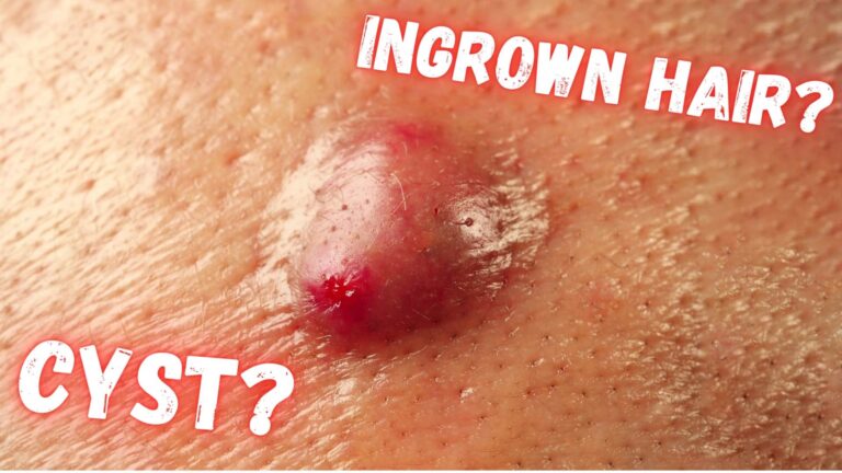 Ingrown Hair Turned into Hard Lump Under Skin: What is it & How to ...