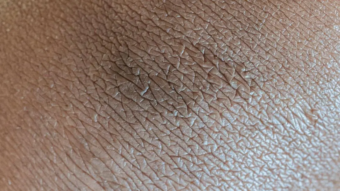 Skin with itching and irritation from yeast infection, showing linear patterns and pigmentation.