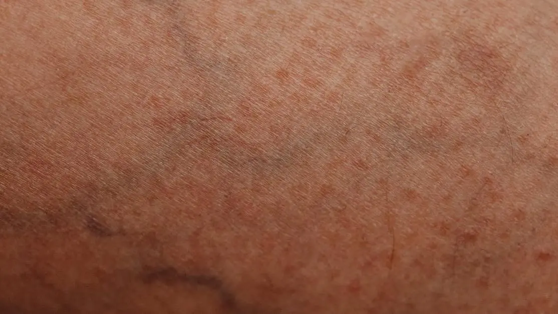 Skin Thinning and Bruising Menopause close-up of skin texture and veins